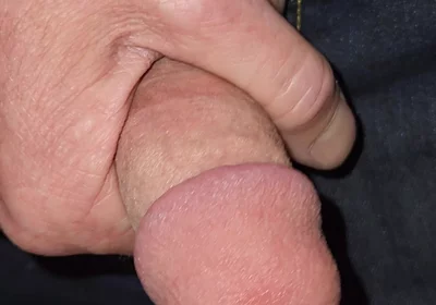 Gaping Urethra - Marker and Pinky Insertion