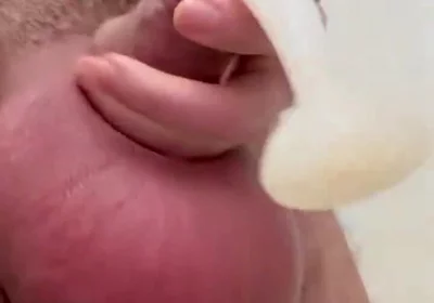 Inflated Ball Sack with Saline