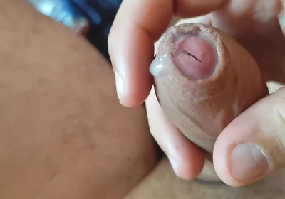 Dilation of the Corpus Cavernosum Exposes Spongy Foreskin.