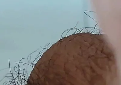 Extreme Open Hole Leaves the Glans Exposed.