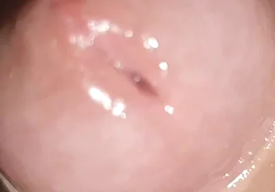 Maximum Dilation of Phimosis Cumming.