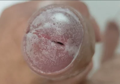 Extreme Burning Sensation Makes the Glans Foam with Arousal.